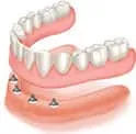Reabilitação total por overdenture